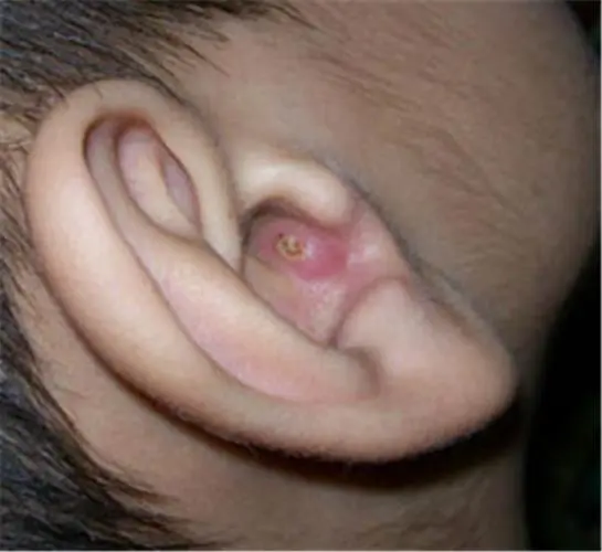 外耳炎症状及应对方法